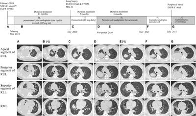 Case report: Target and immunotherapy of a lung adenocarcinoma with enteric differentiation, EGFR mutation, and high microsatellite instability